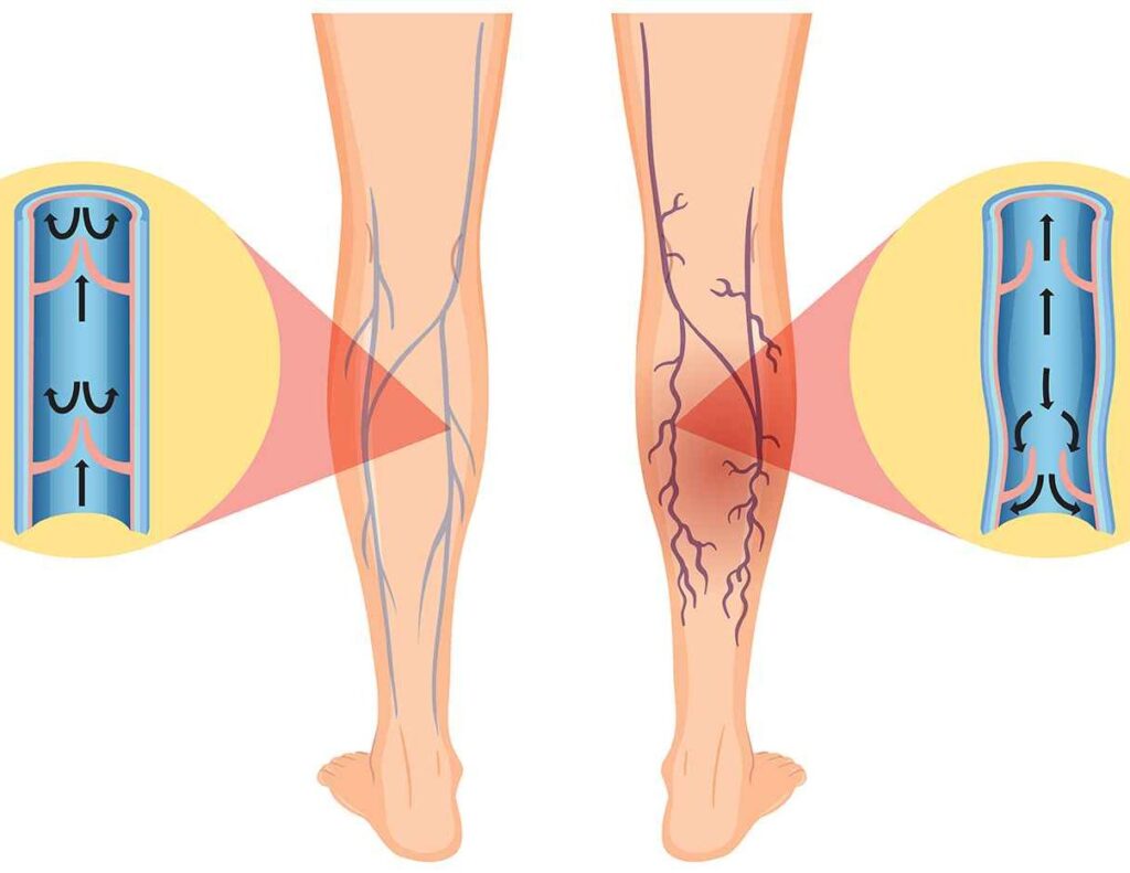 زالو درمانی برای واریس
