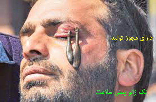 درمان بیماری های چشم و زالو درمانی