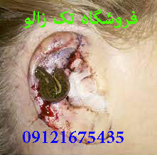 زالو درمانی در بیماران سر و گردن