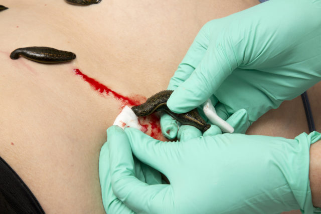 زالو درمانی