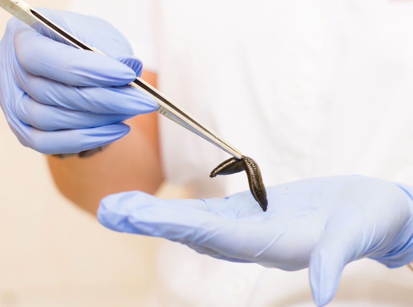 زالوی درمانی