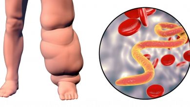 کاربرد حجامت در درمان لنف ادم