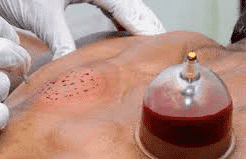 چگونه از شر جای زخم حجامت خلاص شویم؟