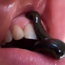 زالو درمانی و التهاب دندان و تحلیل لثه