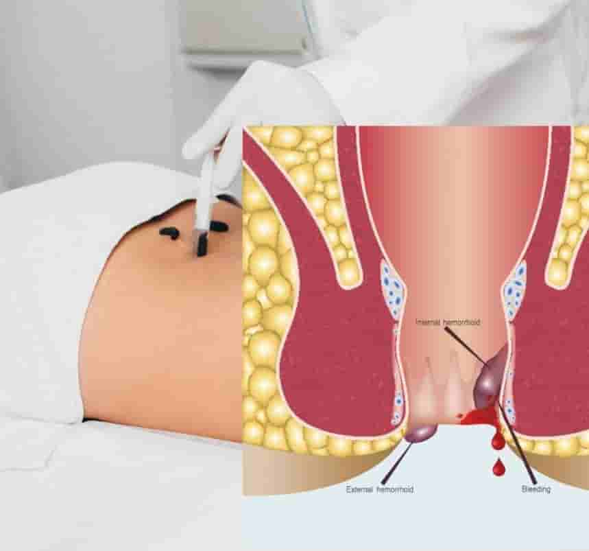 استفاده از زالو در درمان بواسیر