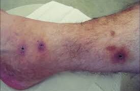  برای استفاده از زالو، محل باید تمیز و عاری از هرگونه ماده شیمیایی باشد و زالوها مستقیماً با دست یا با استفاده از سرنگ باز استفاده می‌شوند و سپس خارج می‌شوند.